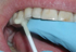 Pic-n-Stic-Handle for Small Objects-Pulpdent-Dental Supplies