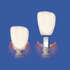 Implant Cement-Premier-Procedure.jpg